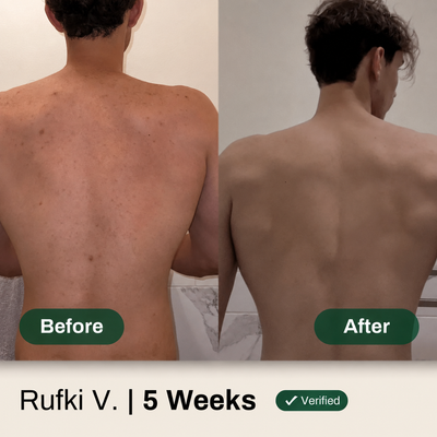 Miracle Body Acne Cleanse - AHA BHA PHA