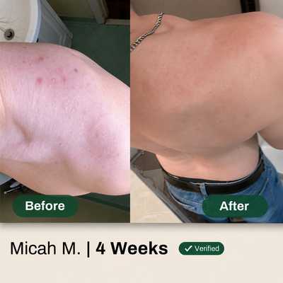 Miracle Body Acne Cleanse - AHA BHA PHA